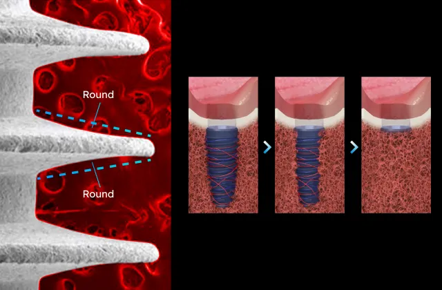 anyone thread width to give sufficient space for angiogenesis