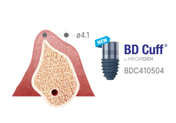 Cuffdiff Beta Implant Diameter Check
